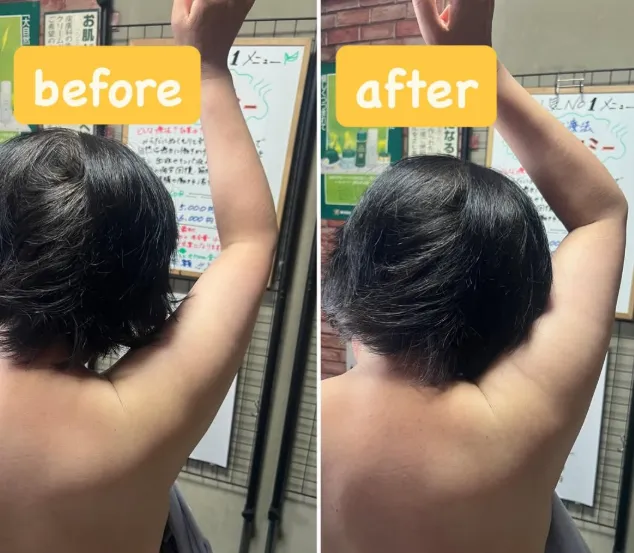 3回目の施術でここまで!上がらなかった肩がしっかり動くように