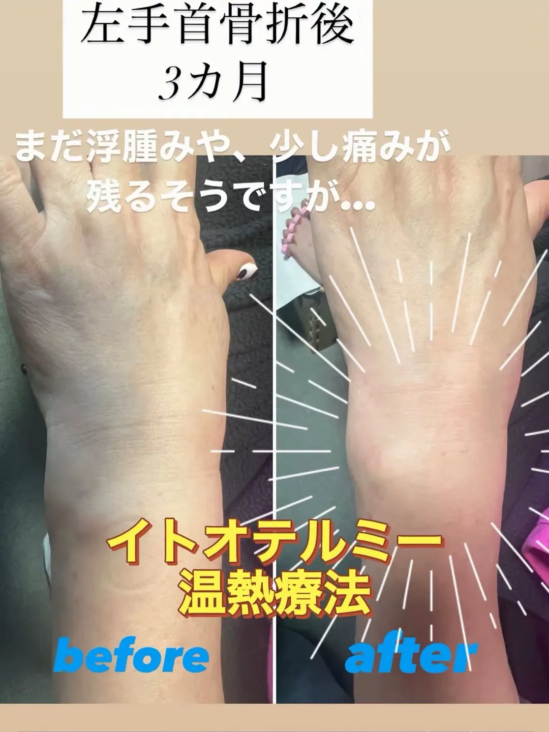 #イトオテルミー